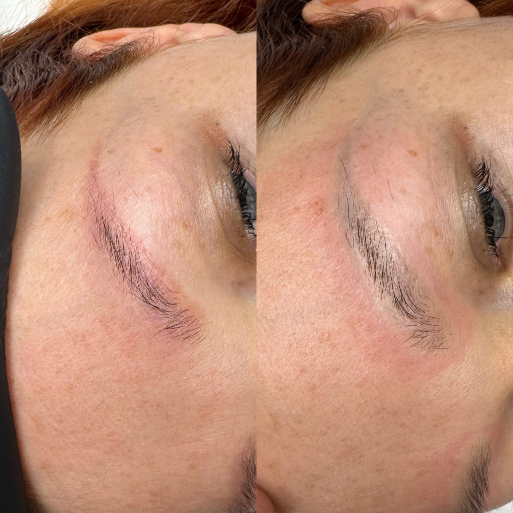 usuwanie, laser, makijaz permanentny usuwanie laserowe